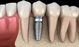 Dental Implants