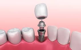 Dental Implants