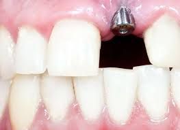 Dental Implants