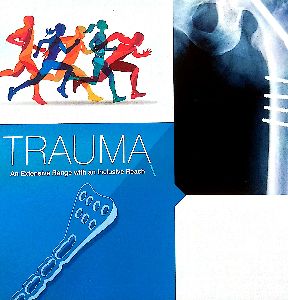 orthopedic trauma implants