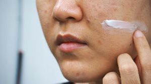 Anti Acne Cream