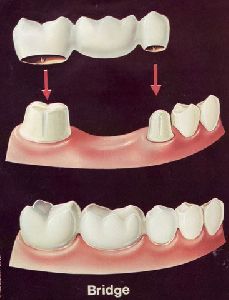 Dental Bridge Treatment Services