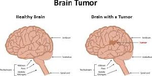 D Brain Tumor