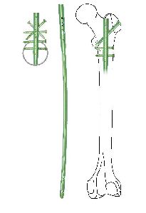 Femoral Bone Hyper Interlocking Nail