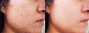 Acne Scar Treatment In Janakpuri, Dwarka