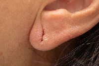 Ear Lobe Repair Treatment