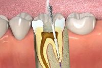 root canal treatment services