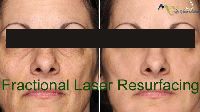 Fractional Laser Treatment