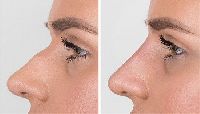 Nose Filler Treatment