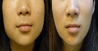 Slimmer Face Treatment