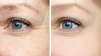 Treat Wrinkles Around the Eyes