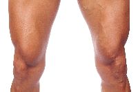 Varicose Veins Treatment Services