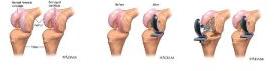 Partial Knee Replacement Surgery