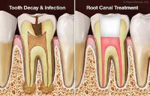 Root Canal Treatment