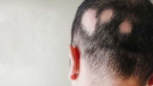 Alopecia Areata Treatment