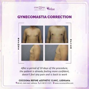 gynecomastia surgery