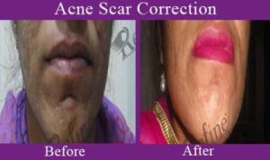 Scar Treatment