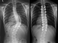 Spinal Deformity Treatment Services