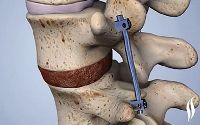 Spinal Fusion Treatment Services