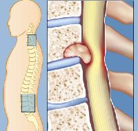 Spinal Tumor Treatment Services