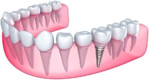 Dental Implant Treatment Services