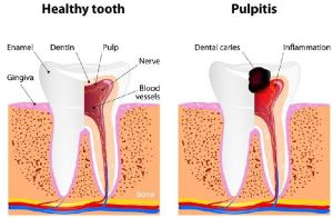 root canal treatment services