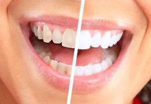 Teeth Whitening Treatment Services