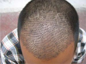 Hair Transplant Services