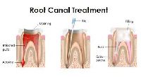 Rootcanal Treatment With Laser