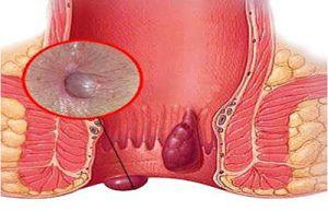 Piles And Fistula Treatment