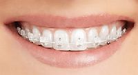 braces treatment services