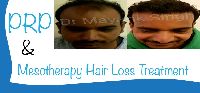 PRP & Mesotherapy Hair Loss Treatment Services
