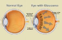Glaucoma Treatment in Mumbai