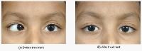Paediatric Ophthalmology Treatment
