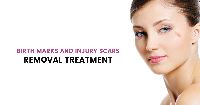 Scars Removal Treatment in Gurgaon