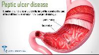 Peptic Ulcer Homeopathic Treatment Services