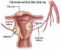 Fibroid Treatment Service