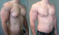 Male Breast Reduction Treatment Services