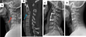 Anterior Cervical Corpectomy Spine Surgery