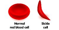 Sickle Cell Anemia Treatment in India