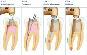 Root Canal Treatment