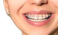 Dental Braces Procedure