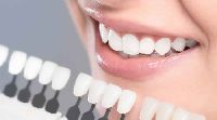 Dental Veneers Treatment Services