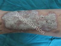 Psoriasis Treatment