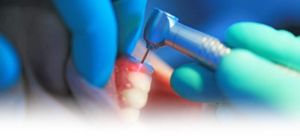 Laser Dentistry Treatment Services