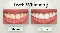 Teeth Whitening Services