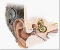 Middle Ear Implant Treatment Services