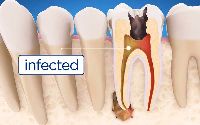 root canal treatment service