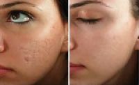 Microneedling Treatment Services