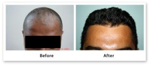 FUT hair transplant